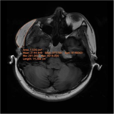 Association Between Fat Graft Retention and Blood Flow in Localized Scleroderma Patients: A Pilot Study